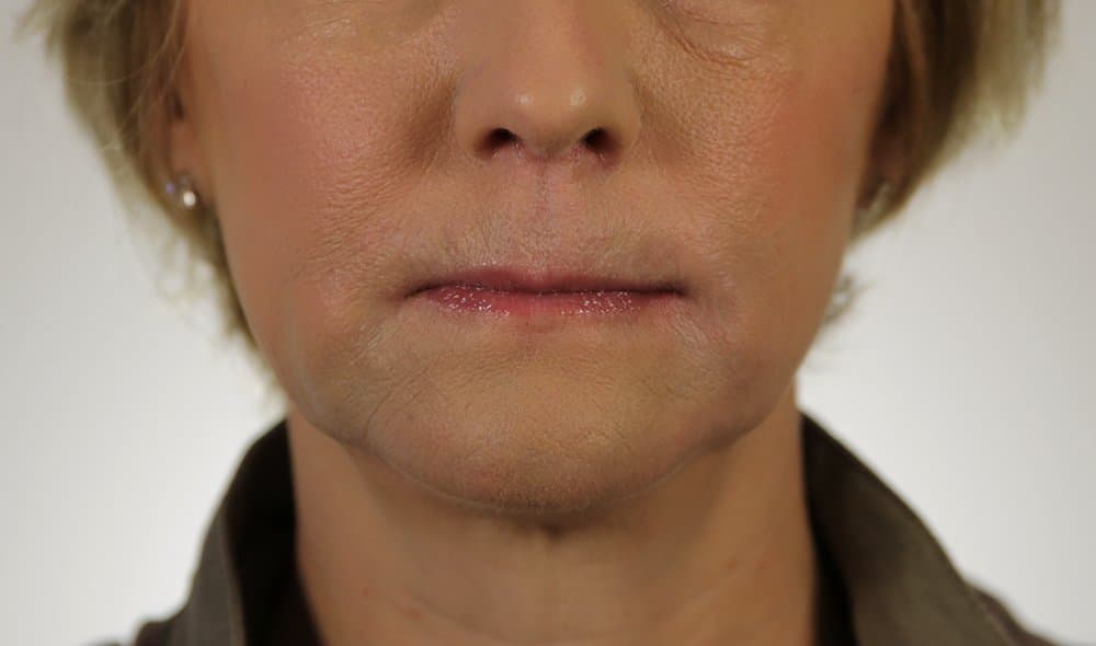 After Revanesse at Nuluk Aesthetics