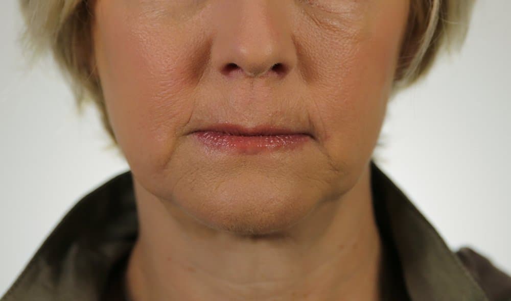 Before Revanesse at Nuluk Aesthetics