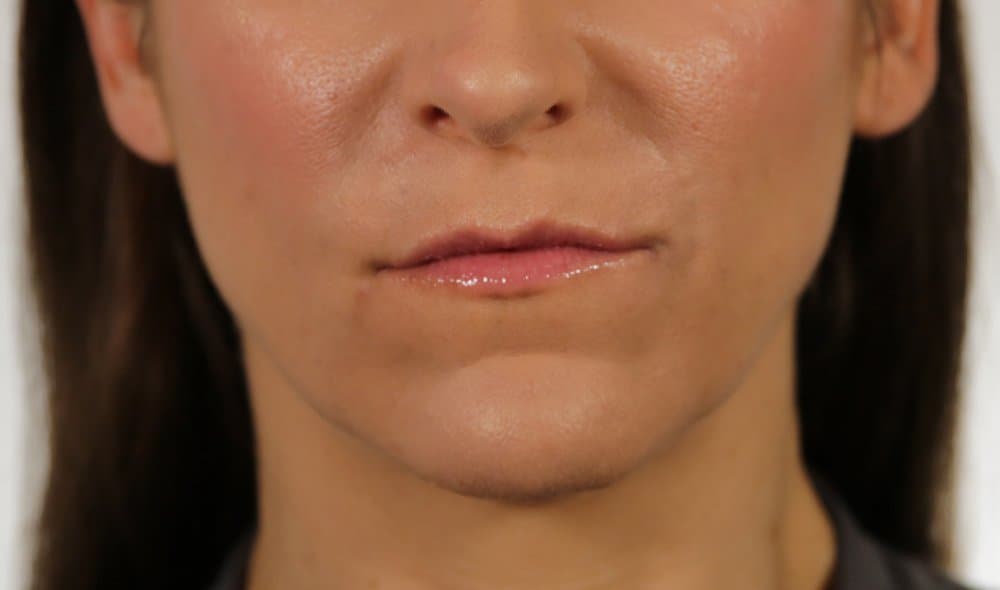 Injectables