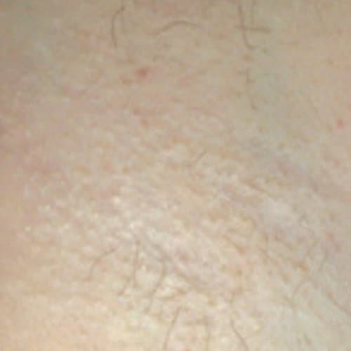 After Laser Hair Removal