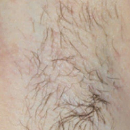 Before Laser Hair Removal