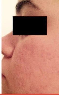 After Microneedling