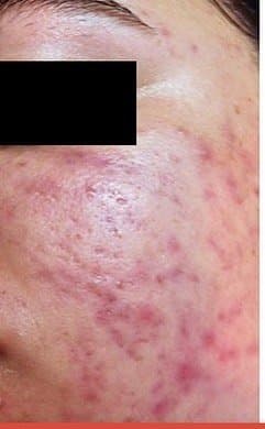 Before Microneedling