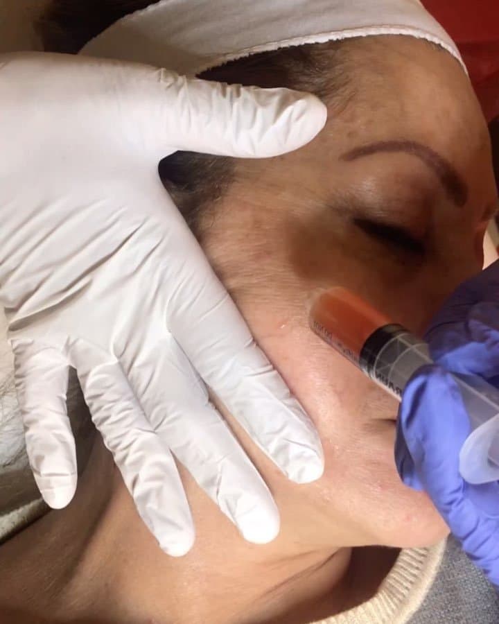PRP Facial