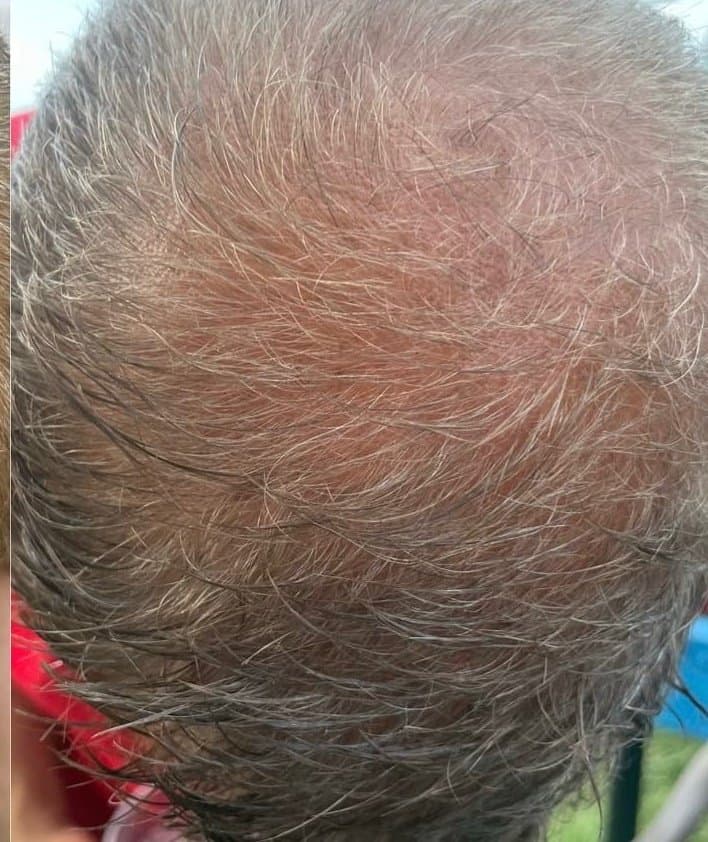 After PRP Hair Loss Treatment