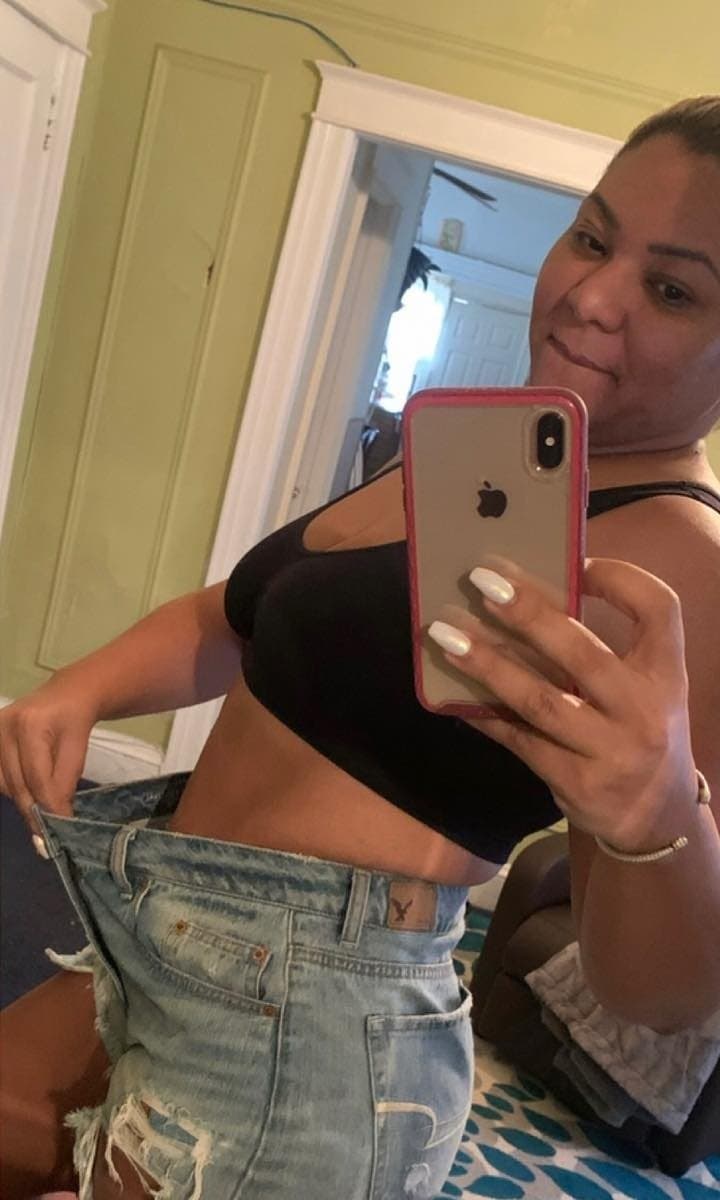 After Medical Weight Loss