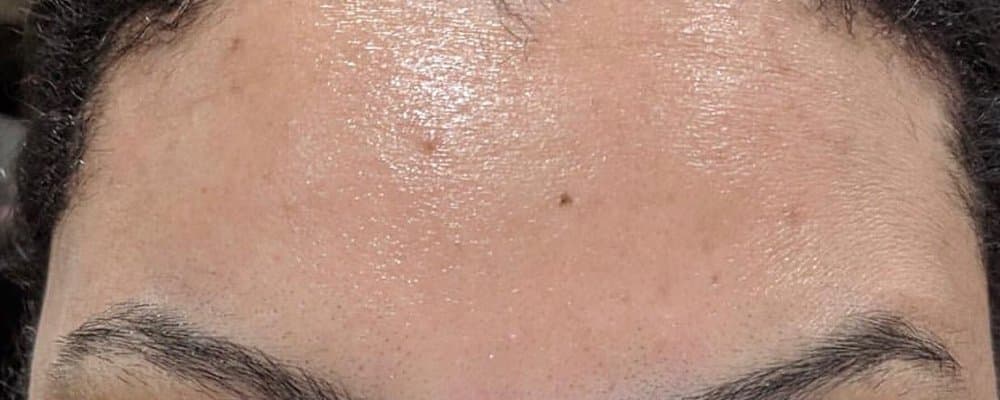 After Xeomin