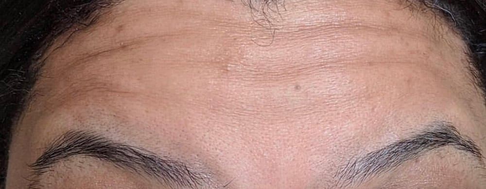 Before Xeomin